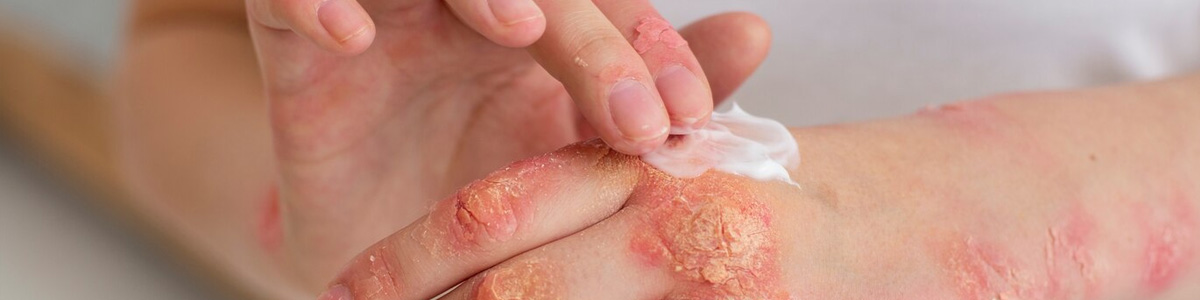 A Importância do Cuidado com a Pele: Prevenindo Problemas Dermatológicos